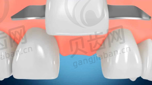 隐适美隐形牙套：独特优势